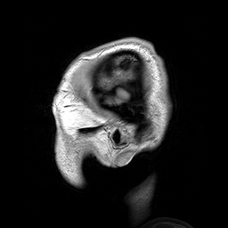 MRI of human brain